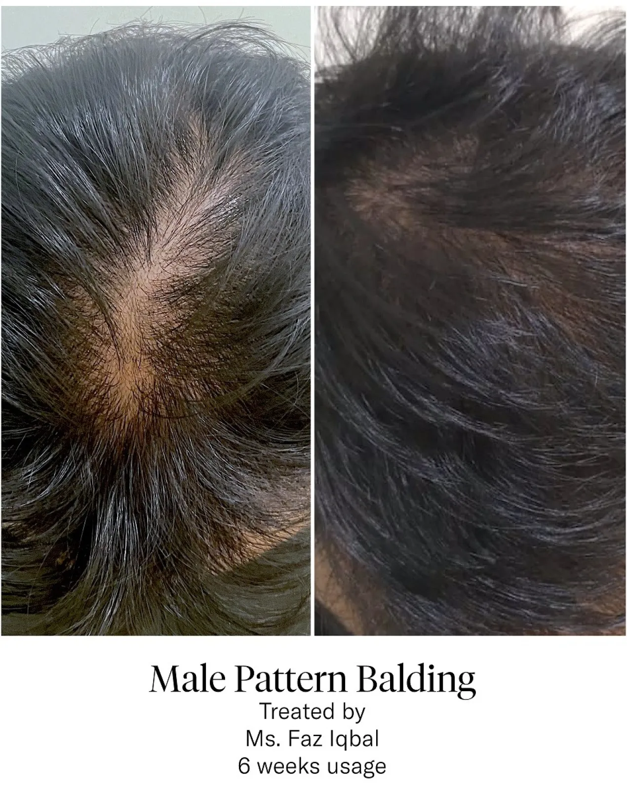 Advanced Hair System Kit Traitement de Régénération Capillaire
