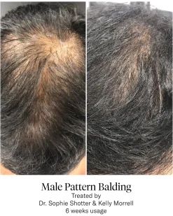 Advanced Hair System Kit Traitement de Régénération Capillaire