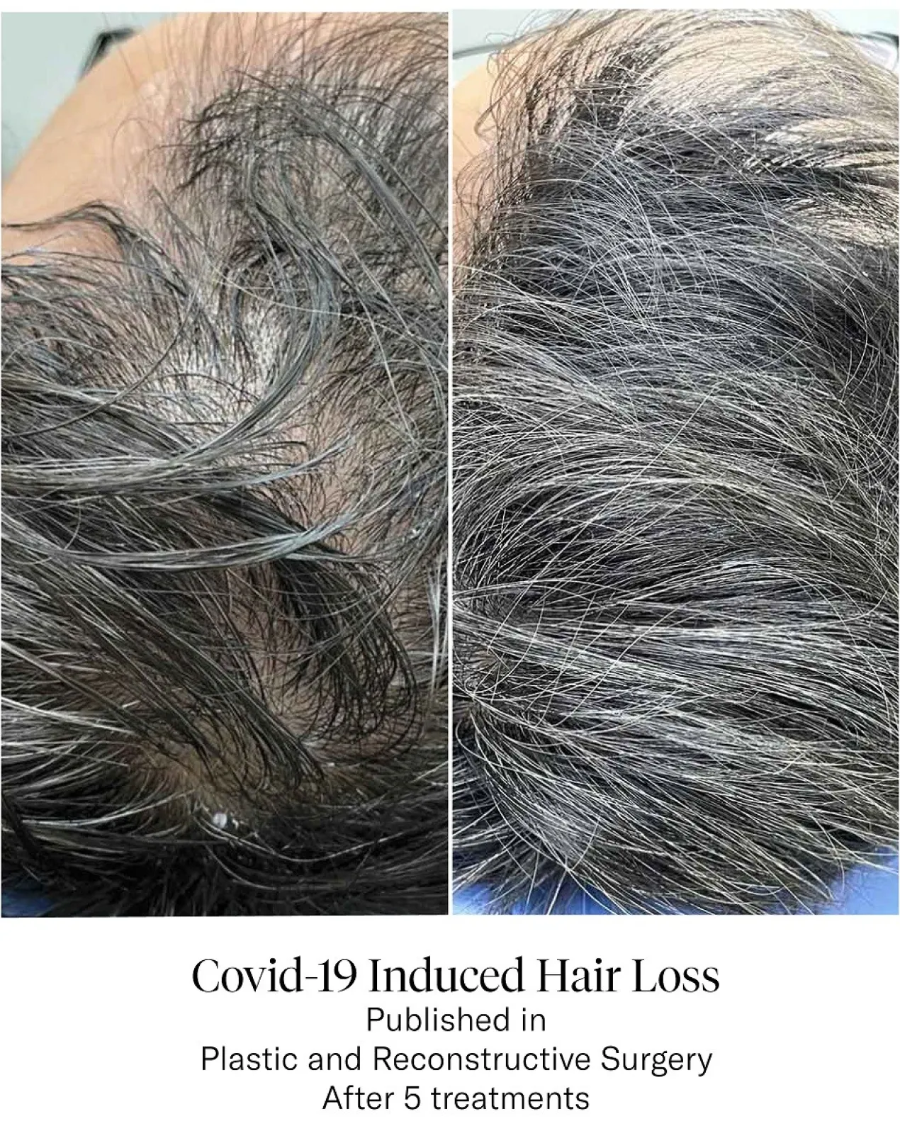 Advanced Hair System Kit Traitement de Régénération Capillaire