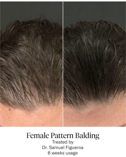 Advanced Hair System Kit Traitement de Régénération Capillaire