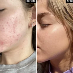 Beta Hydroxy Acid Serum