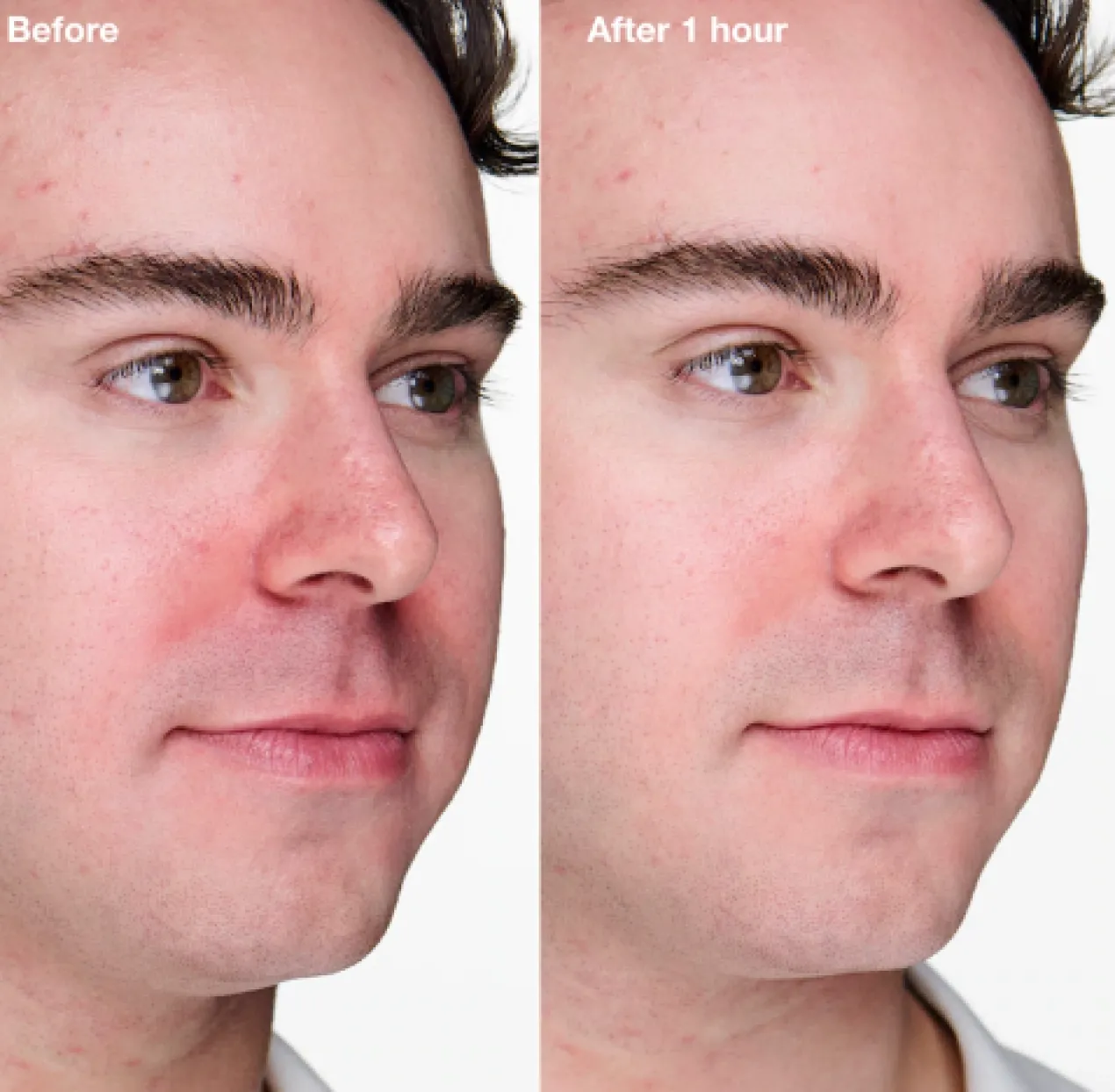 Gel Avancé Anti-Imperfections Anti-Blemish Solutions Clinical
