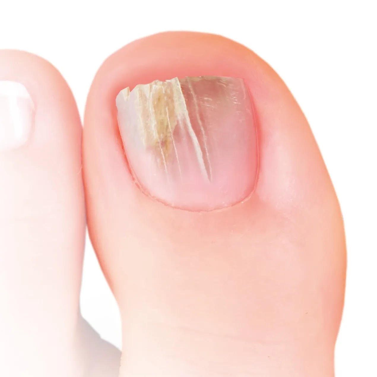 Pinceau Anti-Mycoses des Ongles