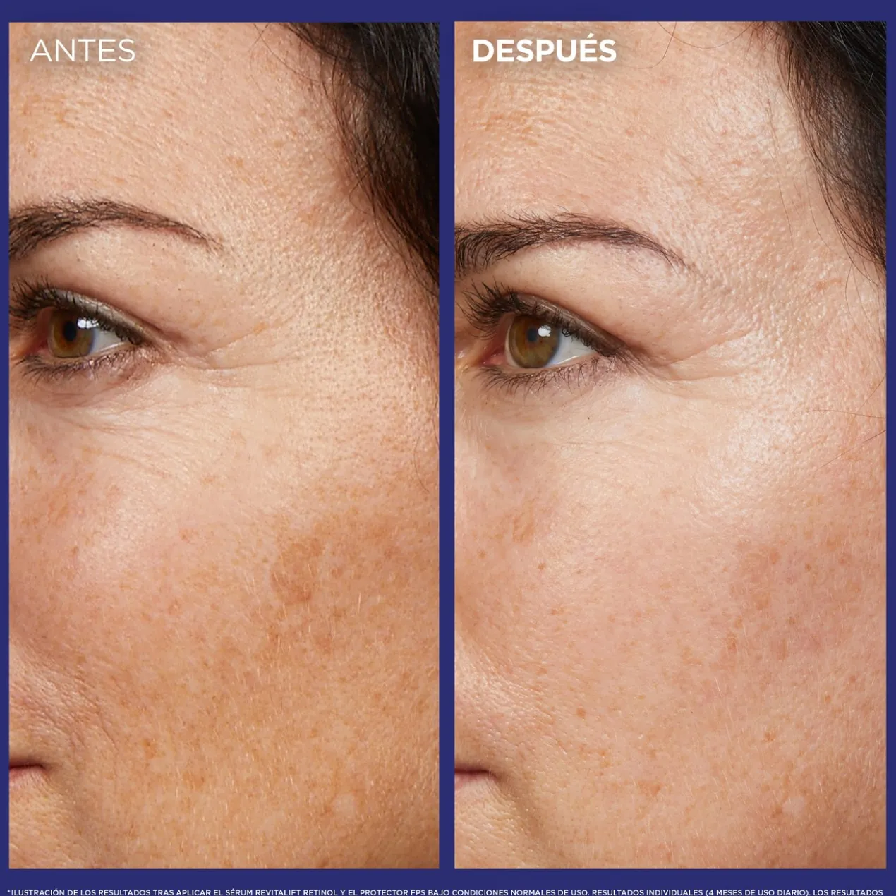 Revitalift Laser Sérum Nuit Rétinol Pur